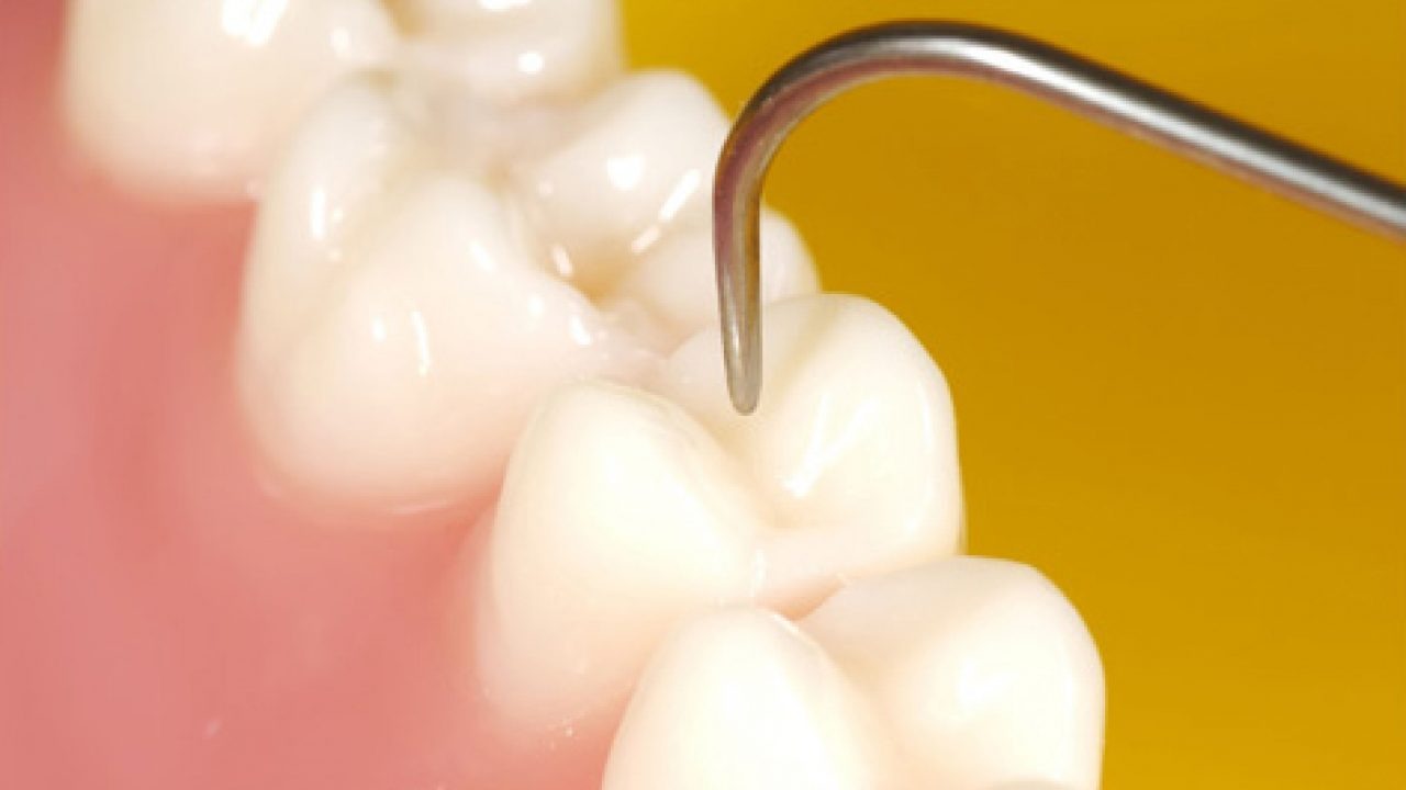 Selladores Dentales: Tu Escudo Contra las Caries