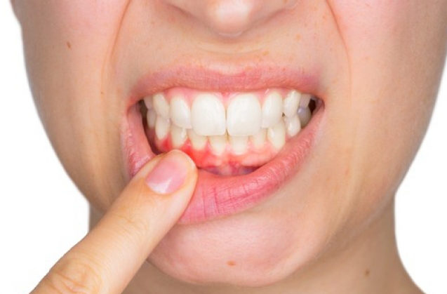 Prevención y Tratamiento de la Gingivitis en Adultos Mayores